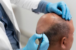 From Balding to Bold: The Journey of Successful Hair Transplants in Turkey
